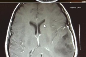 Before and after MRI of brain tumor when treated with Cannabis Oil