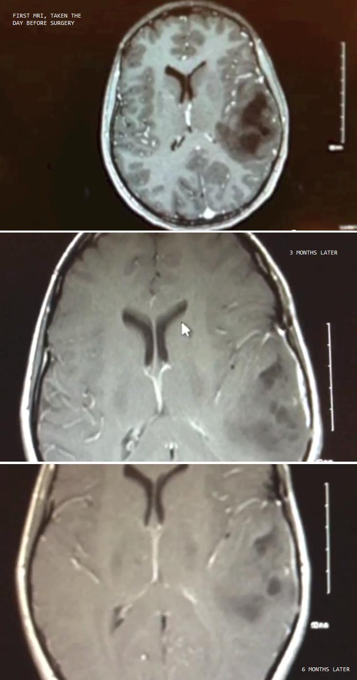 Before and after MRI of brain tumor when treated with Cannabis Oil